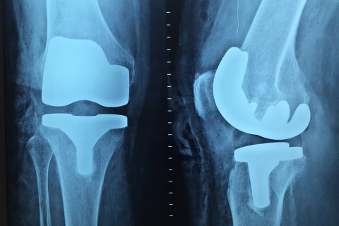Röntgenbild Knie